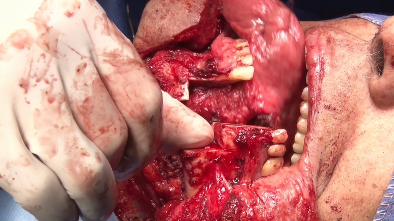 Base of the Tongue